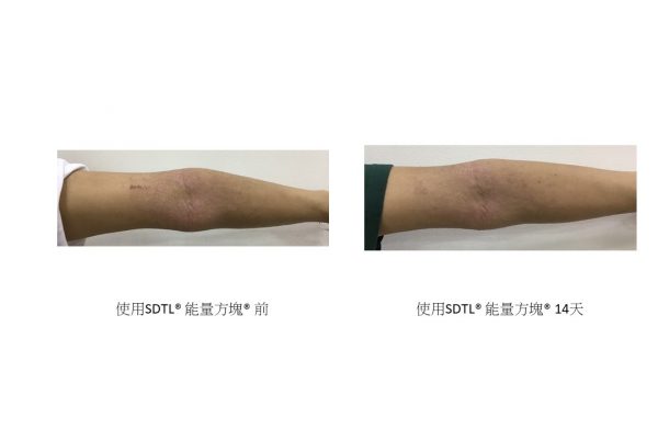 Eczema Compare 1