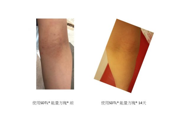 Eczema Compare 2