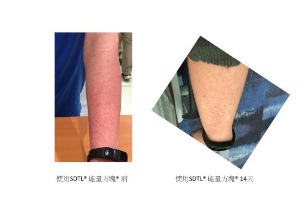 Eczema Compare 3