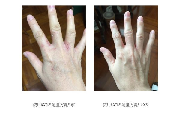 Eczema Compare 4