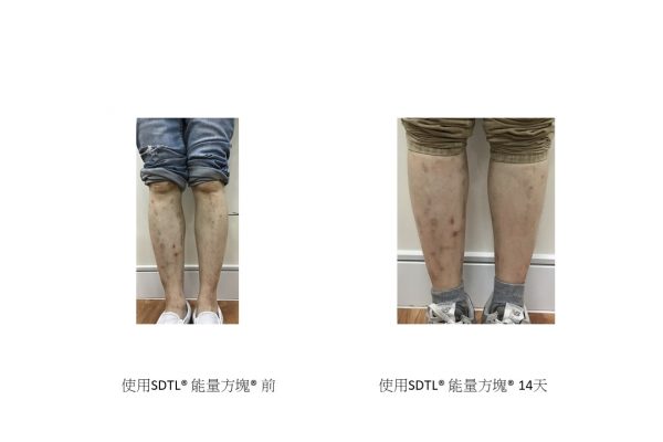 Eczema Compare 5